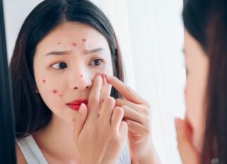 6 Foods to Avoid If You Want to Keep Your Skin Acne-Free
