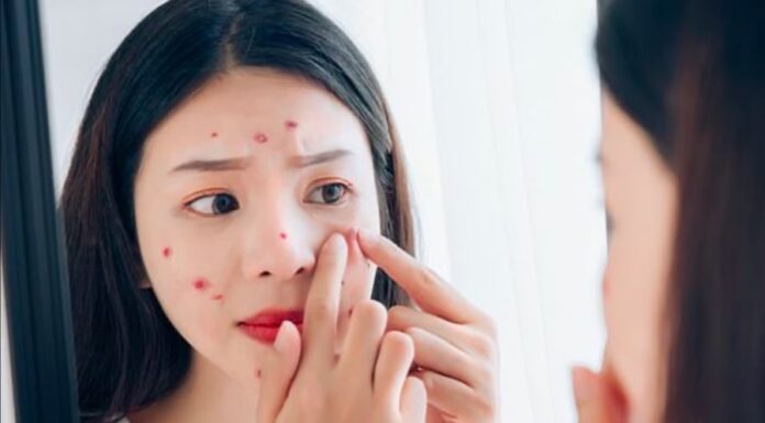 6 Foods to Avoid If You Want to Keep Your Skin Acne-Free