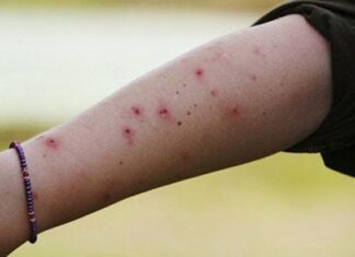 The Ultimate Hack to Stop the Itch: Fast Relief from Mosquito and Insect Bites