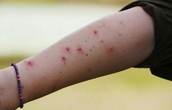 The Ultimate Hack to Stop the Itch: Fast Relief from Mosquito and Insect Bites