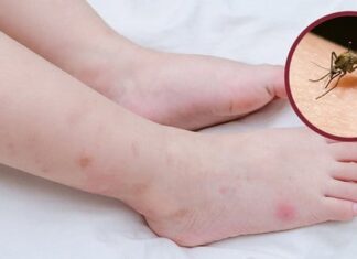 The Ultimate Guide to Mosquito Bite Relief: Easy Tips to Soothe the Itch and Prevent Swelling