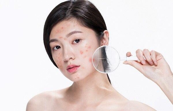 “5 Super Ingredients to Banish Skin Blemishes: Achieve Flawless Skin Without the Spa Price Tag”