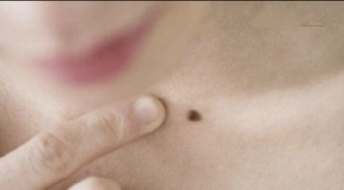 The Lucky Seven: Moles That Bring a Lifetime of Bliss