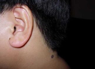 The 9 Moles That Attract Wealth and Fortune: A Lucky Sign That Brings Prosperity