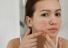 7 Simple Tips to Get Rid of Acne Scars at Home