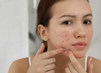 7 Simple Tips to Get Rid of Acne Scars at Home