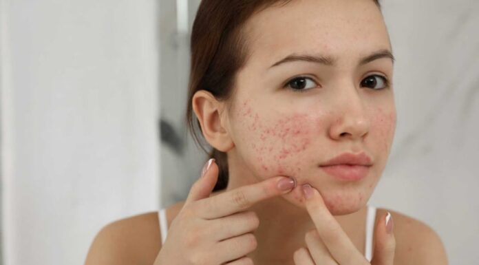 7 Simple Tips to Get Rid of Acne Scars at Home