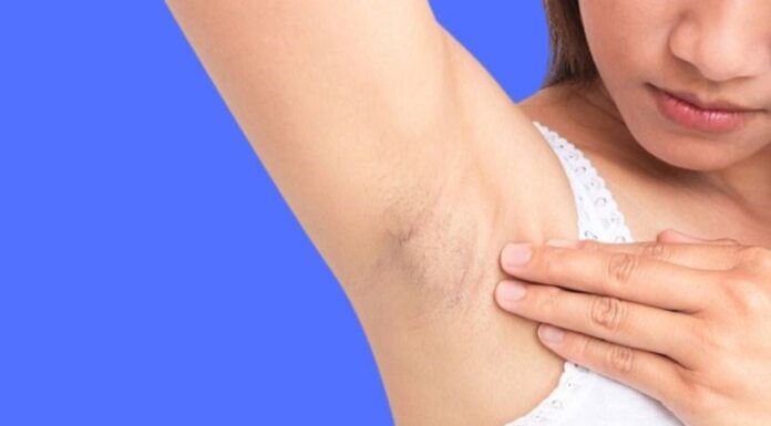 The Ultimate Guide to Underarm Darkness: 5 Simple Strategies for Brighter Skin