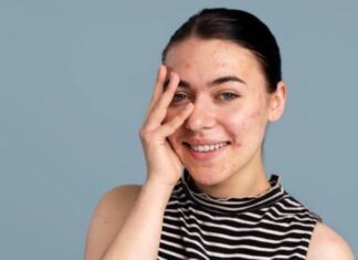 The Ultimate Guide to Flawless Skin: 8 Quick Makeup Tips for Acne-Prone Complexions
