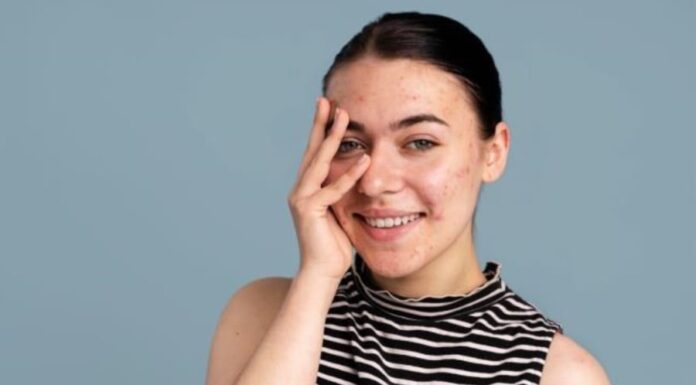 The Ultimate Guide to Flawless Skin: 8 Quick Makeup Tips for Acne-Prone Complexions
