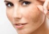 To Eradicate Melasma, Women Should Adhere to These 4 Golden Rules