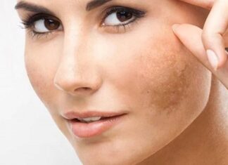 To Eradicate Melasma, Women Should Adhere to These 4 Golden Rules