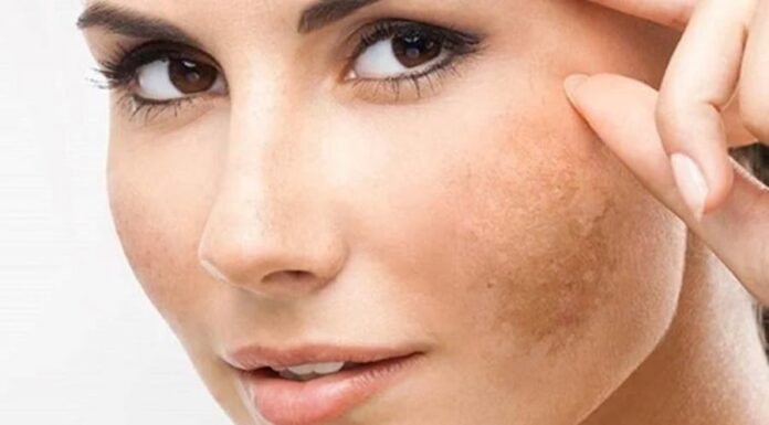 To Eradicate Melasma, Women Should Adhere to These 4 Golden Rules