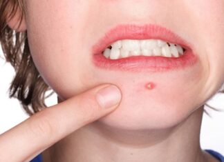 7 Simple Home Remedies to Get Rid of Cystic Acne
