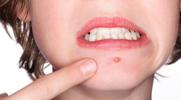 7 Simple Home Remedies to Get Rid of Cystic Acne