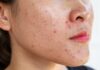 “The Ultimate Guide to Teenage Acne: Causes and Cures”
