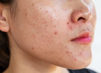 “The Ultimate Guide to Teenage Acne: Causes and Cures”
