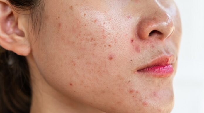 “The Ultimate Guide to Teenage Acne: Causes and Cures”