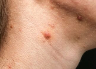 The Ultimate Guide to Tackling Neck Acne: Causes and Simple Solutions