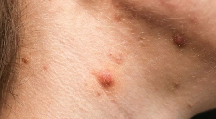 The Ultimate Guide to Tackling Neck Acne: Causes and Simple Solutions