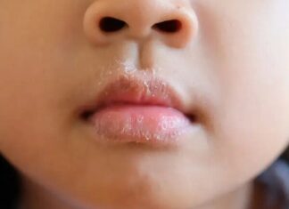 “Don’t Neglect Your Child’s Delicate Complexion This Winter”