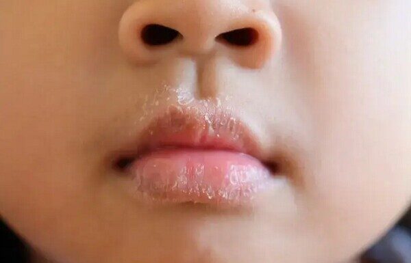 “Don’t Neglect Your Child’s Delicate Complexion This Winter”