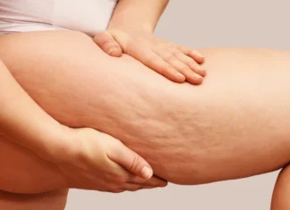 “Battling ‘Orange Peel’ Skin: 4 Simple Home Remedies to Boost Confidence and Embrace Your Beauty”