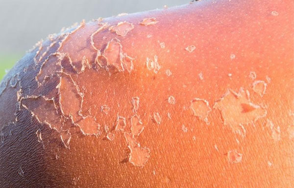 How to Treat Sunburned Skin?
