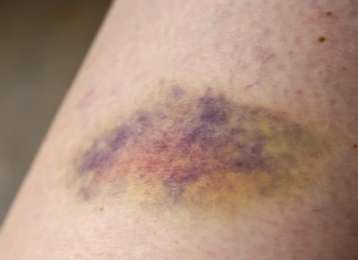 The Ultimate Guide to Vitamin C Deficiency: 5 Warning Signs You Should Never Ignore