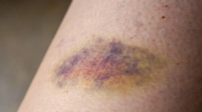 The Ultimate Guide to Vitamin C Deficiency: 5 Warning Signs You Should Never Ignore