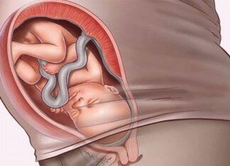 What is Breech Presentation? How to Identify a Breech Presentation