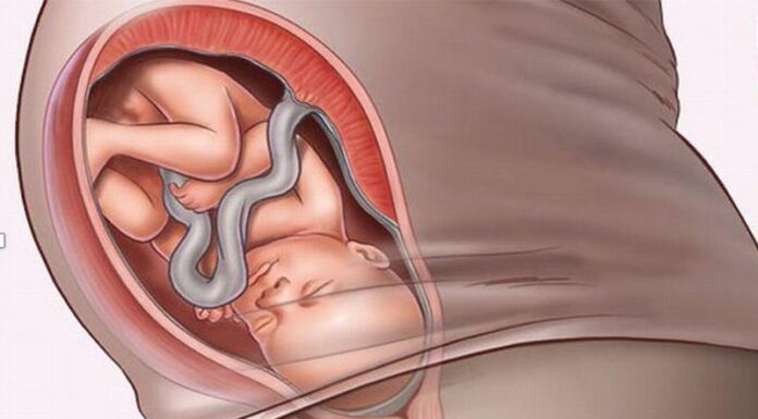 What is Breech Presentation? How to Identify a Breech Presentation