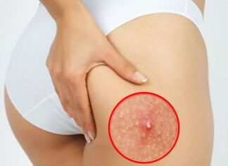 The Ultimate Guide to Clear, Glowing Skin: 7 Acne-Busting Tips for a Flawless Behind