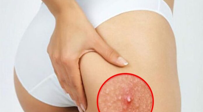 The Ultimate Guide to Clear, Glowing Skin: 7 Acne-Busting Tips for a Flawless Behind