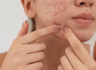 Is It Safe for Pregnant Women to Squeeze Pimples? Pimple Treatment for Expectant Mothers