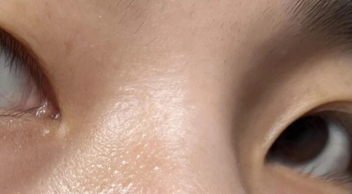 “Is Your Face Wash Causing Those Stubborn Blackheads?”