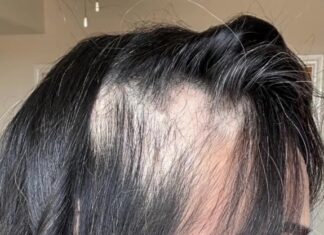 The Three Commandments to Rescue Your Hair from a 70% Loss, as Told by a TikToker.