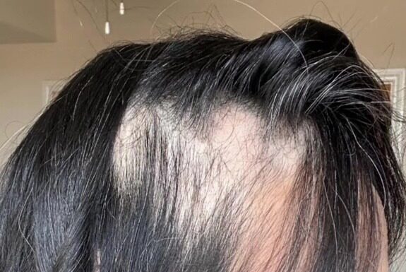 The Three Commandments to Rescue Your Hair from a 70% Loss, as Told by a TikToker.