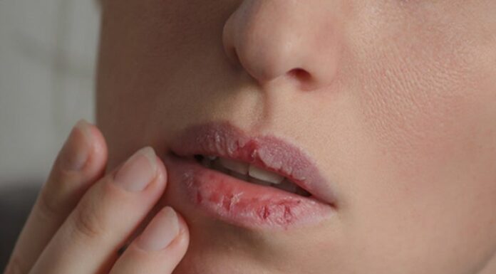 What Causes Dry Lips and How Can You Effectively Treat Them?