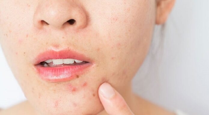 The 3 Most Common Skin Problems in Spring and Easy Fixes