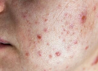 Avoid These Ingredients When Battling Pregnancy Acne