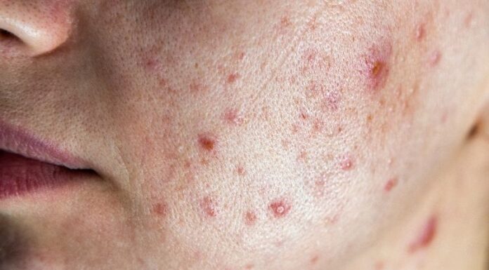 Avoid These Ingredients When Pregnant and Battling Acne