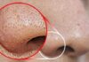 5 Simple Ways to Get Rid of Blackheads on Your Nose at Home