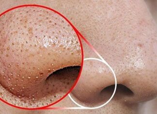 5 Simple Ways to Get Rid of Blackheads on Your Nose at Home