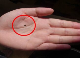 The Man with a Mole in This Spot is Filthy Rich