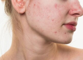 The Ultimate Guide to Acne-Prone Skin Makeup: Flawless Looks Without Irritation