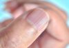 Why Do Fingernails Have Vertical Ridges? 4 Warning Signs of Health Problems.
