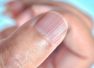 Why Do Fingernails Have Vertical Ridges? 4 Warning Signs of Health Problems.