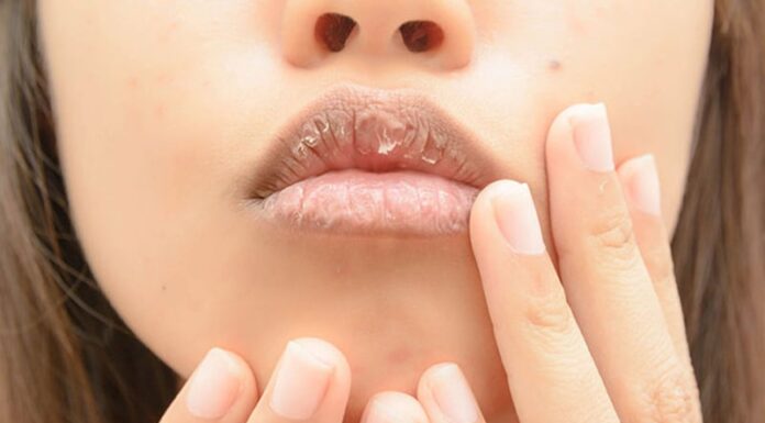 The Ultimate Hack to Rescue Chapped Lips Post-Gloss Application