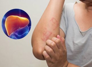 The Four Warning Signs That Your Liver Disease Has Progressed to an Advanced Stage: When You Should Seek Medical Attention.